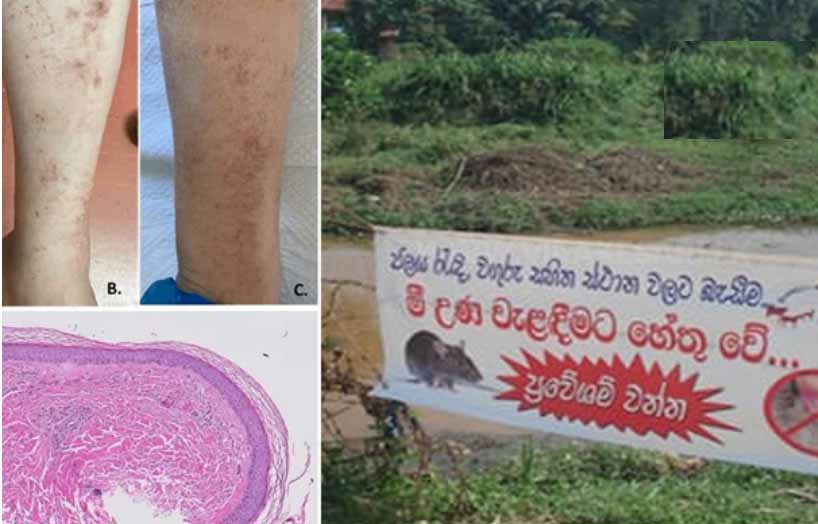உயிரைக் குடிக்கும் எலிக் காய்ச்சல்